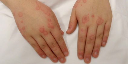 Allergia hideg megnyilvánuló néz ki, mint a kéz és az arc, népi jogorvoslati irritációtól
