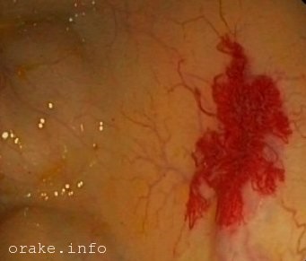 Angiodysplasia - a rák a fotó (angiodysplasia) Angiodysplasia - a rák fotó