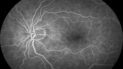 Angiodystonia retina - mi ez