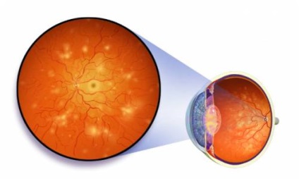 retinális vaszkuláris angiopátia szem tünetek és a kezelés