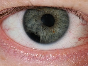 retinális vaszkuláris angiopátia szem okok és a tünetek a betegség, hogyan kell kezelni ezt a betegséget