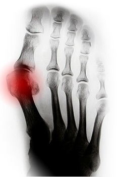osteoarthritis lábközépcsont