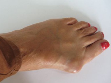 Osteoarthritis lábközépcsont okok, tünetek, kezelés (fotó) (közös) Osteoarthritis lábközépcsont okok, tünetek, kezelés (fotó)