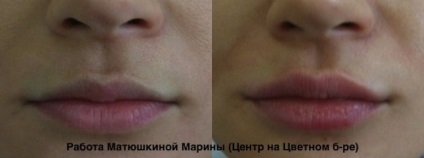Az aszimmetria az ajkak az arcon oka, hogyan kell rögzíteni
