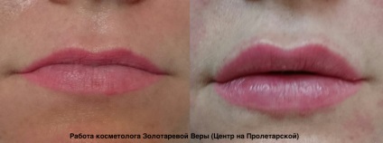 Az aszimmetria az ajkak az arcon oka, hogyan kell rögzíteni