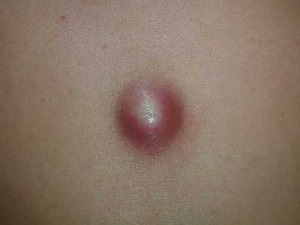 Wen hátán és módszereit, hogyan lehet megszabadulni belőle (atheroma) Wen hátán és módszereit, hogyan lehet tőle megszabadulni