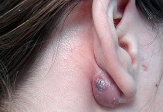 Atheroma a fül és a fül lebeny - kezelésére ciszták