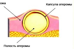 Atheroma fül és annak kezelése (atheroma) Atheroma fül és annak kezelése