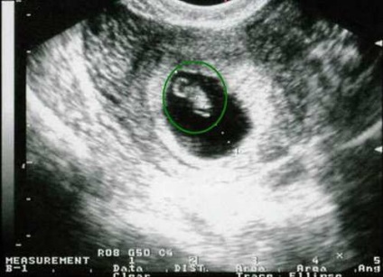 Terhesség 5. hét szülési magzati fotó
