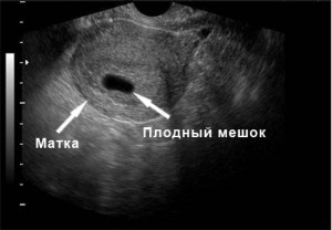 Terhesség 5. hét szülési magzati fotó