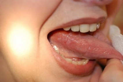 Gyulladt nyelv oldalán a gyökere duzzanatot okoz a szélek körül, mint a gyógyítás