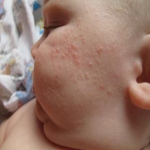 A kenet allergiás kiütés kenőcs alatti gyermekek egyéves - szól allergia