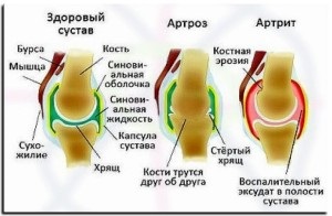 Mi más, mint az arthritis, arthrosis a térdízület hasonlóságok és különbségek