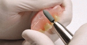 Mi van, ha a fogsor megdörzsöli