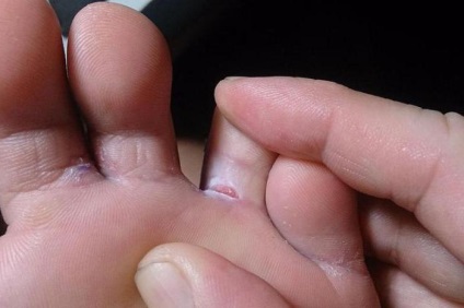 kezelése indított láb és köröm gombás nail fungus szegfűszeg