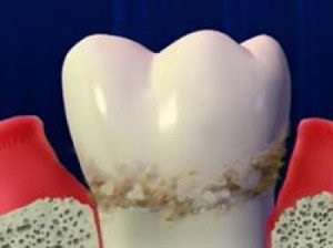 Mi van, ha nem voltak kövek a fogakat, mint ezek veszélyesek mintegy harapás korrekciója és fogszabályozó
