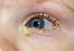 Mi a teendő, ha a gyermek szeme elmérgesedni