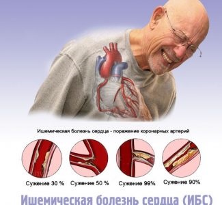 Cubendokardialnaya ischaemia jelei az EKG (iszkémia) Cubendokardialnaya ischaemia jelei az EKG