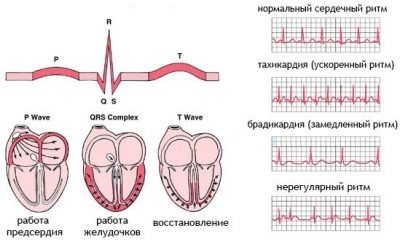 Cubendokardialnaya ischaemia jelei az EKG (jelek) Cubendokardialnaya ischaemia jelei az EKG