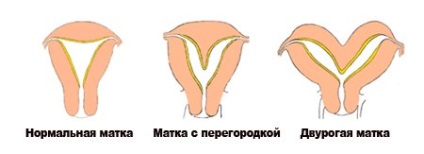 Bicornuate méh (bicornuate) kétszarvú méh