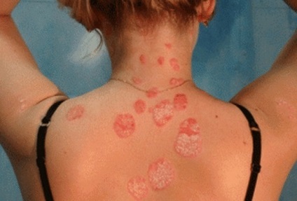 Hatékony módon leküzdésére psoriasis (pikkelysömör) Hatékony módon kezelni psoriasis