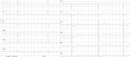 EKG szívritmus zavarok