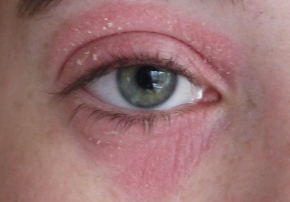 atópiás dermatitis szem