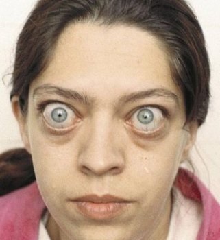 Exophthalmus és enophthalmusa - kezelésére, a tünetek, a megelőzés (kezelés) Exophthalmus és enophthalmusa - kezelésére, a tünetek, a megelőzés
