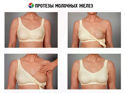 Biológiai protézisek mell miért van szükség, egy fotó és videó vélemény (mirigy) Biológiai protézisek mell miért van szükség, egy fotó és videó vélemény