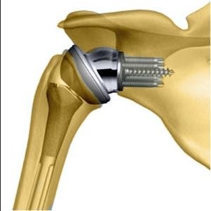 Belső protézis a vállízület - az okok, javallatok és ellenjavallatok