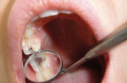 Tooth pecsétje garancia jog és mennyi készül (a pecsét) Tooth pecsétje garancia jog és mennyi készül