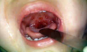 Herpes anginás panaszok a gyermekek, a szövődmények kezelésére