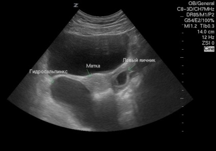 Hydrosalpinx ultrahang vizsgálat lehetőségek