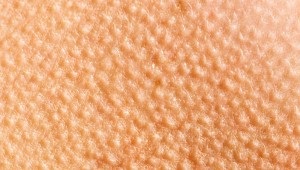 Hyperkeratosisát bőr okok és a kezelés