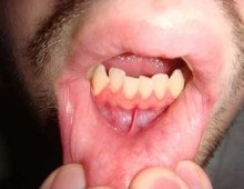 Hipertrófiás fogínygyulladás - diagnózis és a ritka betegségek kezelésére (diagnosztikai) Hipertrófiás fogínygyulladás - diagnózis és a ritka betegségek kezelésére