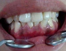 Hipertrófiás fogínygyulladás - diagnózis és a ritka betegségek kezelésére