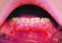 A fogágybetegség (parodontitis) okai, tünetei és kezelési lehetőségei