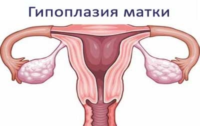 Hypoplasiája méh okoz, tünetek és diagnózis (tünetek) Hypoplasiája méh okoz, tünetek és diagnózis