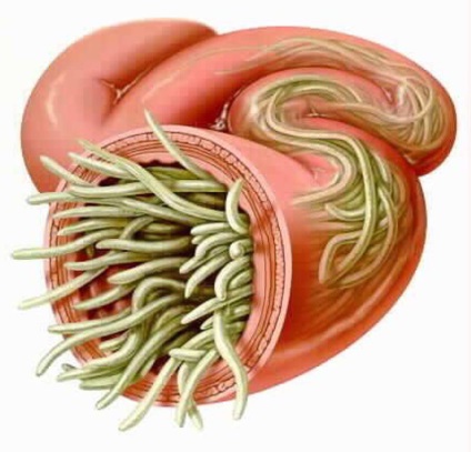 Worms a tüdőben tünetei és kezelése paraziták (fotó)