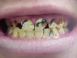Rothadó fogak gyermek baba fotó és fél éves fogak nélkül