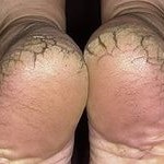 Burning feet - okok és a kezelés, a hagyományos orvoslás