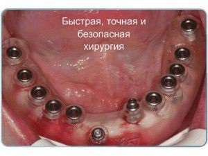 Az implantátumok nélkül forgácsolófogak íny modern beültetés (fog) fogászati implantátumok vágás nélkül az íny modern implantációs