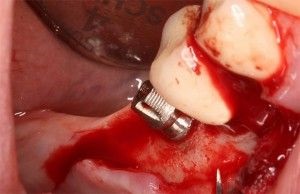 Az implantátumok nélkül forgácsolófogak íny modern beültetés (fogíny) fogászati implantátumok vágás nélkül az íny modern implantációs