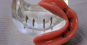 fogászati ​​implantátumok vágás nélkül az íny modern implantációs