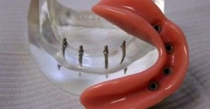 Az implantátumok nélkül forgácsolófogak íny modern beültetés (fog) fogászati implantátumok vágás nélkül az íny modern implantációs
