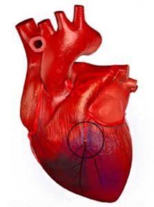 hogy a szívkoszorúér-betegség milyen hatással van az egészségére