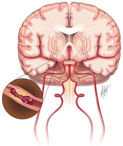 Ischaemiás stroke oka az ischaemiás stroke patogenezisében és klinika