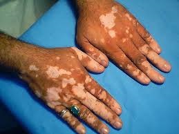 A kutatók azt találták egy új kezelési módszer a vitiligo