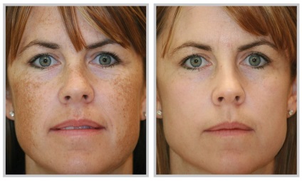 Hogyan lehet megszabadulni a szenilis pigment foltok az arcon