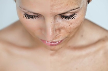 Hogyan lehet megszabadulni a szenilis pigment foltok az arcon
